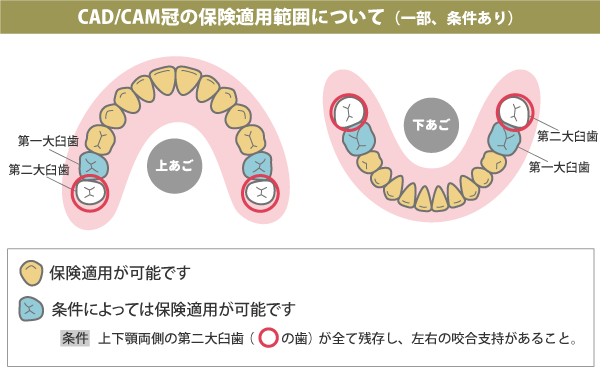 保険でできるリーズナブルな白いかぶせ物！