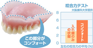コンフォート義歯（自費治療）