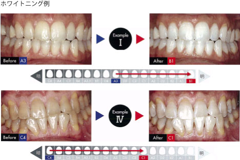 ビヨンドホワイトニングの効果例